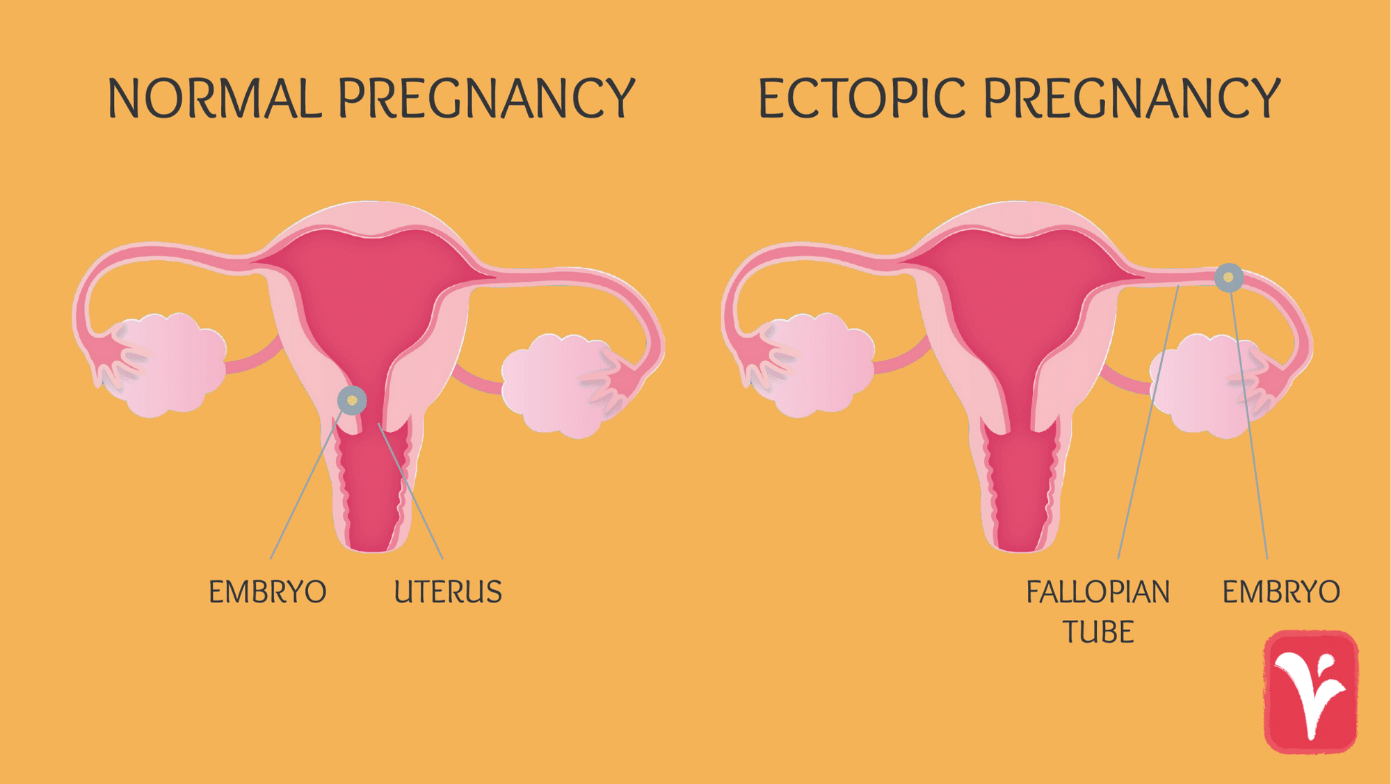 Ectopic Pregnancy Image