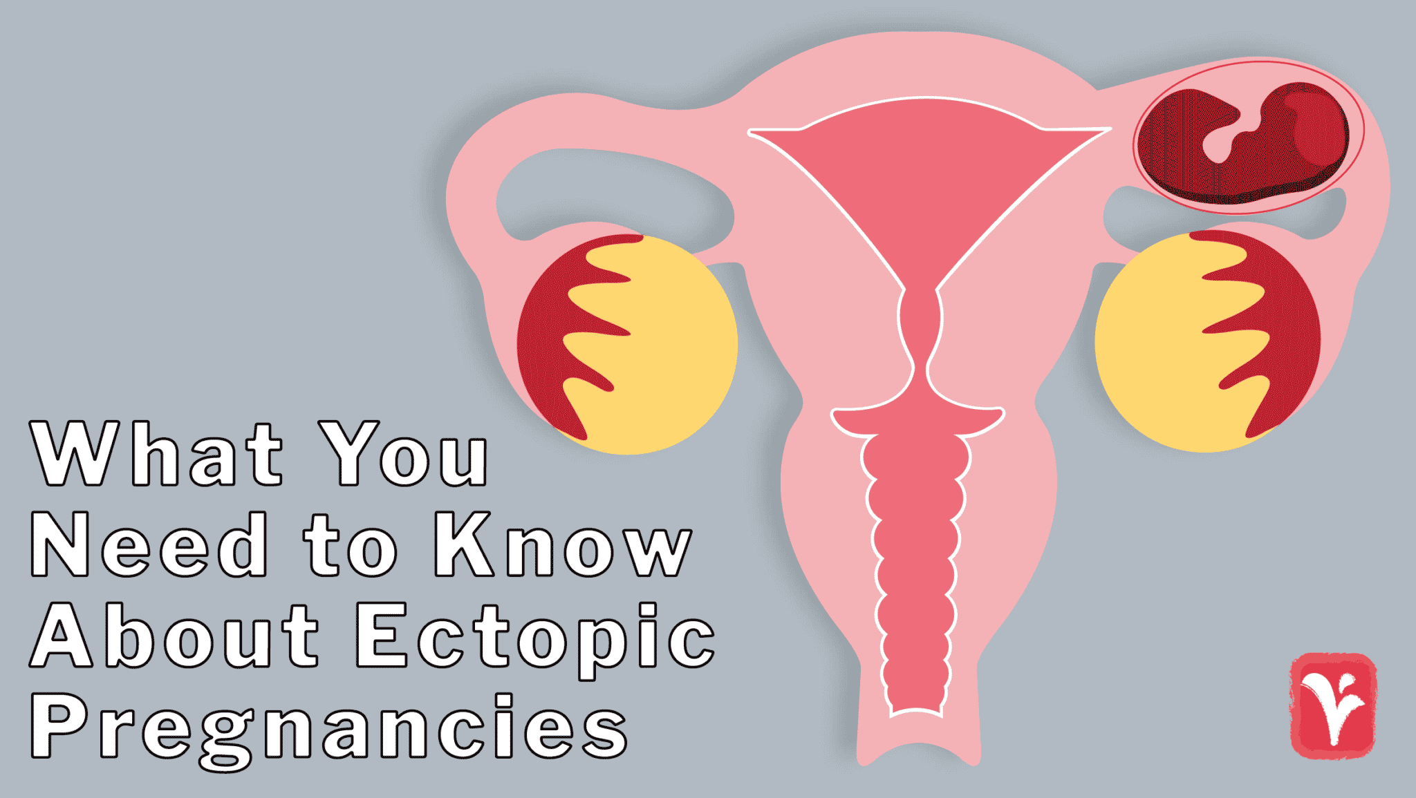 About Ectopic Pregnancies